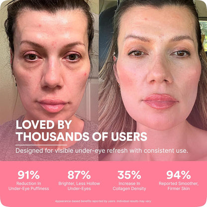 BOTANIQUE PARIS® RevitalEyes Under Eye Red Light Therapy [WITH ANTI EYE BAG CREAM] - Light Therapy Device Bundle for Under Eye Bags, Puffiness & Fine Lines - Skincare Tool for all Skin Types